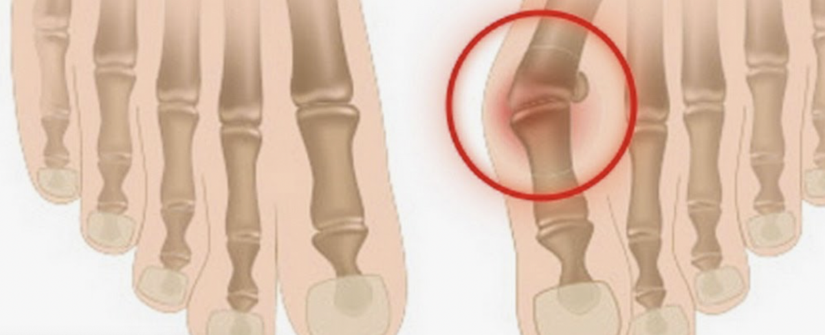 Teknik Pemulihan dan Relaksasi Kaki bagi Pemilik Valgus